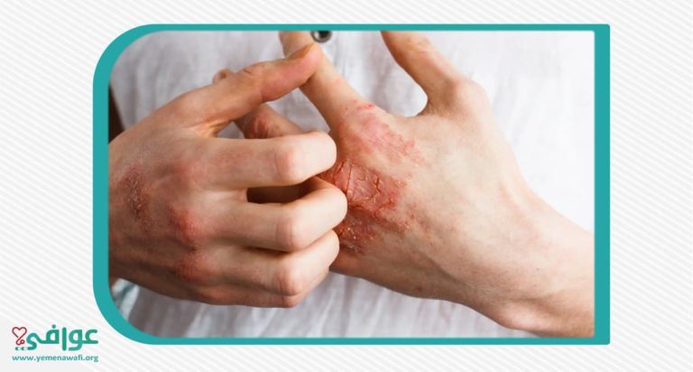 أمراض الجلد في الشتاء وطرق الوقاية منها