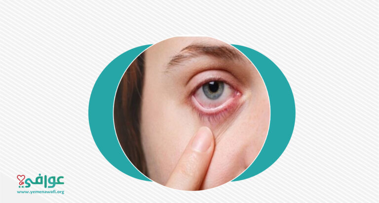 كيف تتجنب الإصابة بالتهاب ملتحمة العين